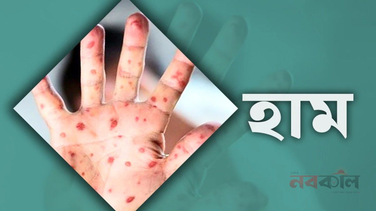 হামের উপসর্গে ২৪ ঘণ্টায় ৪ মৃত্যু, আক্রান্ত ৯১৭